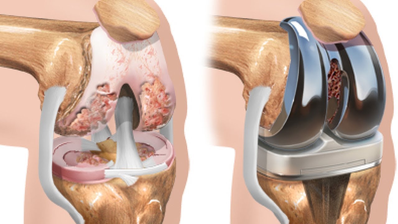 Artroplastia de joelho: o que é e quando é indicado este tipo de ...